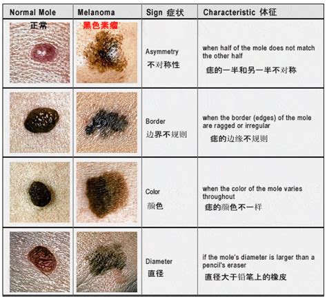 左手臂突然長痣|痣也可能会癌变！长在 3 个地方要注意